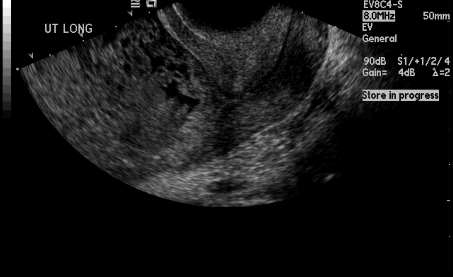 <p>Uterus Ultrasound,&nbsp;Molar Pregnancy. Molar pregnancy displays a "snowstorm-like" appearance.</p>