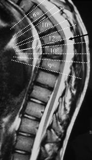 Sagittal MRI demonstrating anterior wedging of >/= 5 degrees in 3+ adjacent vertebral bodies, as described in the diagnostic criteria for Scheuermann's kyphosis