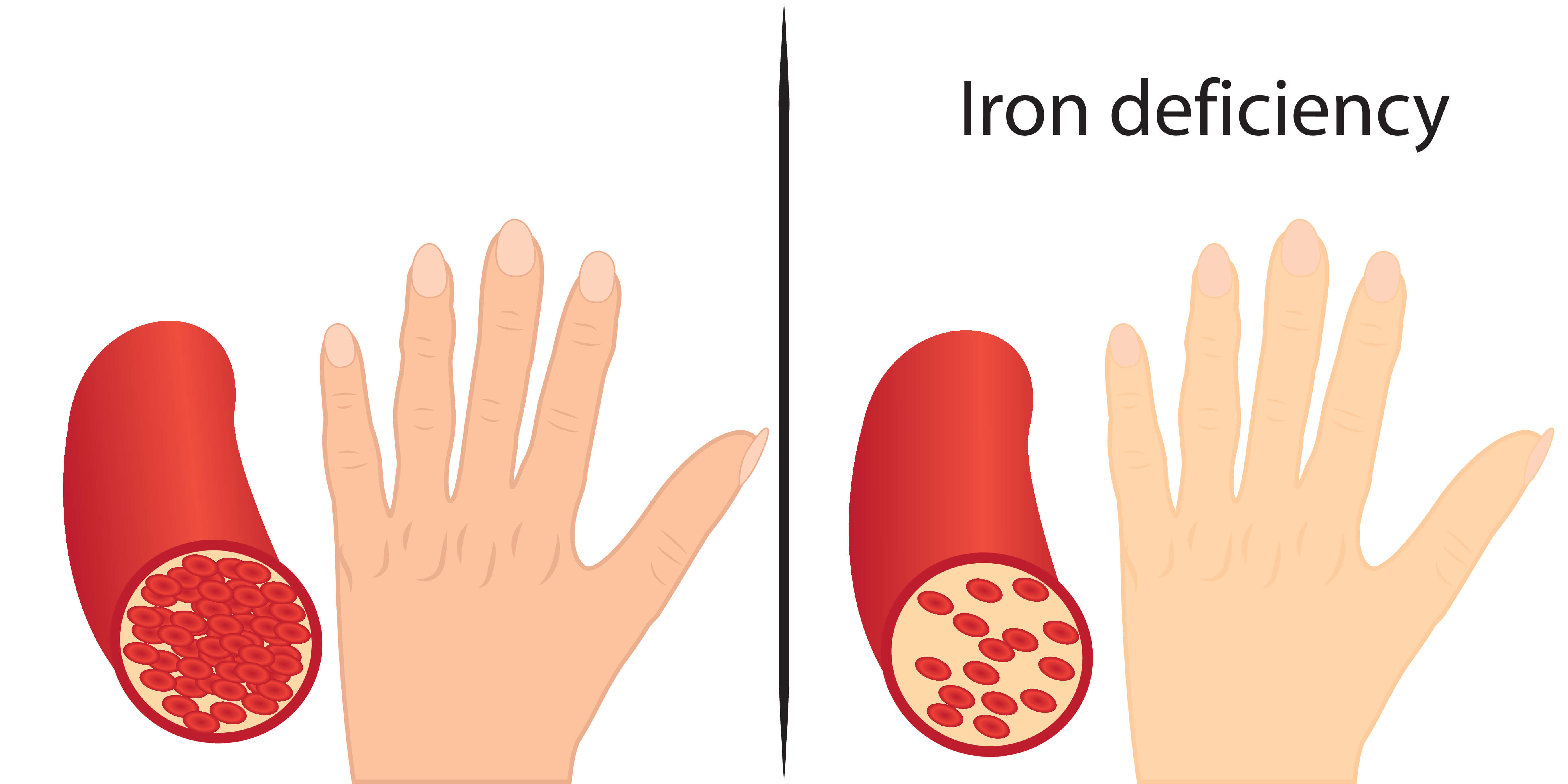 CME Activity | Iron Deficiency Anemia | Osteopathic Medicine