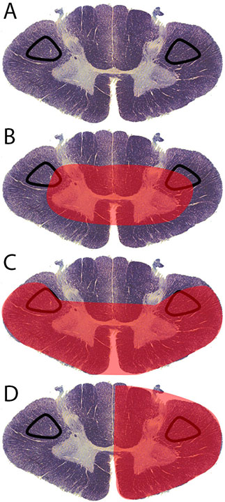 Corticospinal tract lesion locations
(A)	Normal spinal cord cross section. (B) Area affected by central 
cord syndrome (C) Area affected by anterior cord syndrome (D)
area affected by Brown-Sequard syndrome.
