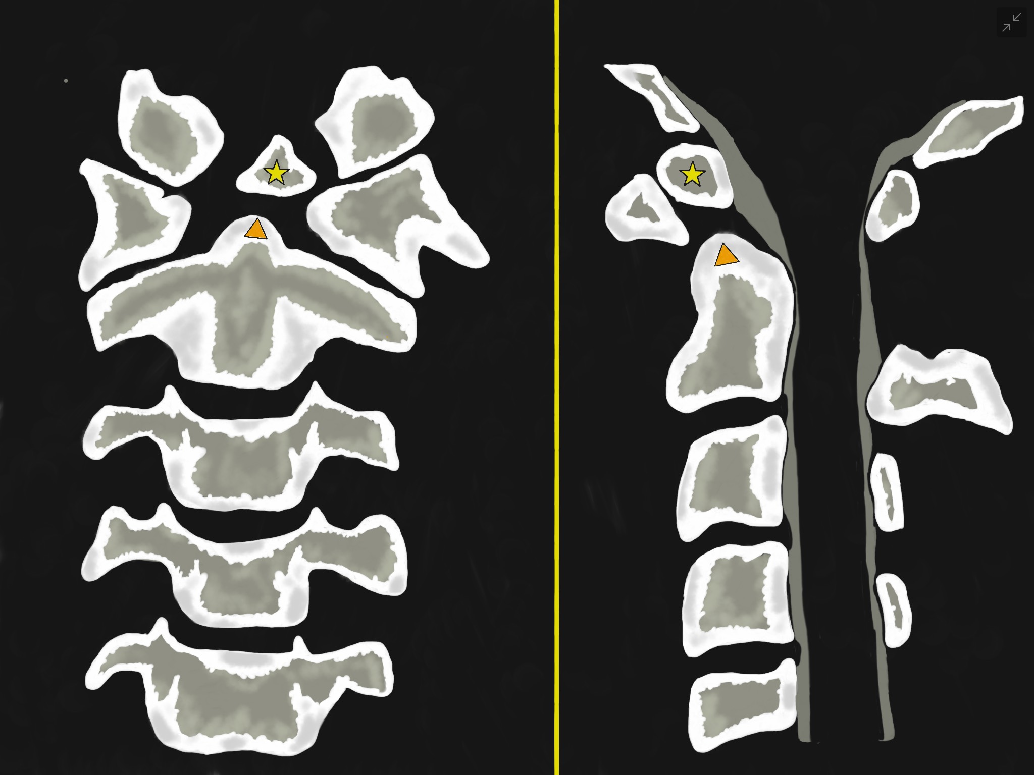 Figure 1 - Illustrations of Os Odontoideum in an anterior-posterior (left-sided image) and lateral (Right-sided image) views. They show an oval or round-shaped ossicle with smooth circumferential cortical margins (yellow star) representing a hypoplastic odontoid process (Orange triangle) that has no continuity with the C2 vertebral body. It often attached to the anterior arch of C1 through an intact transverse ligament.