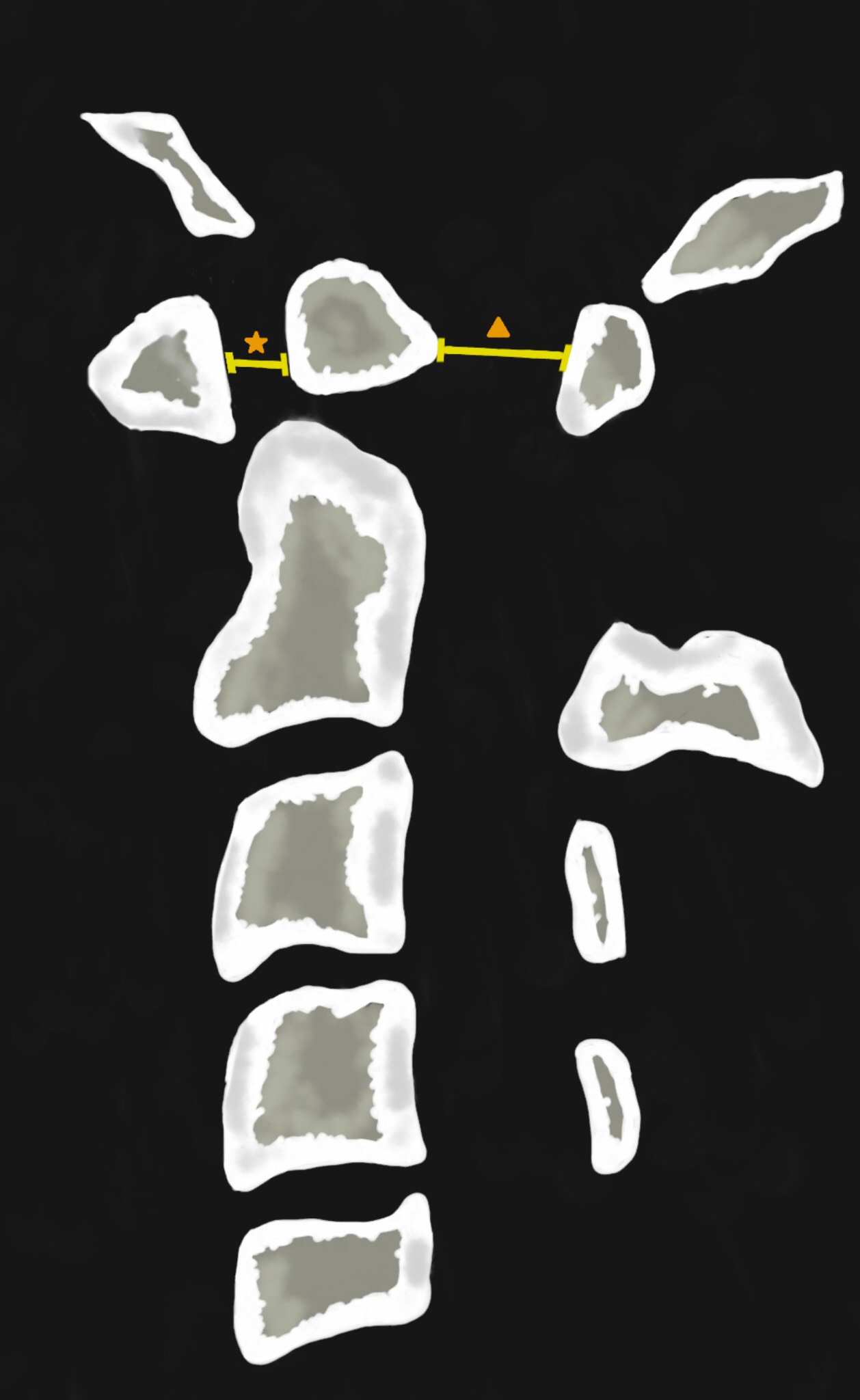 Figure 1 - Illustration that represents an upper cervical spine lateral view. It shows an oval or round-shaped ossicle with smooth circumferential cortical margins representing a hypoplastic odontoid process that has no continuity with the C2 vertebral body. The atlanto-dens interval (ADI) (orange star) is the distance between the odontoid process and the posterior border of the anterior arch of the atlas. The space-available-cord (SAC) or posterior atlanto-dens-interval (PADI) (orange triangle) is the distance between the posterior surface of dens and the anterior surface of the posterior arch of the atlas.