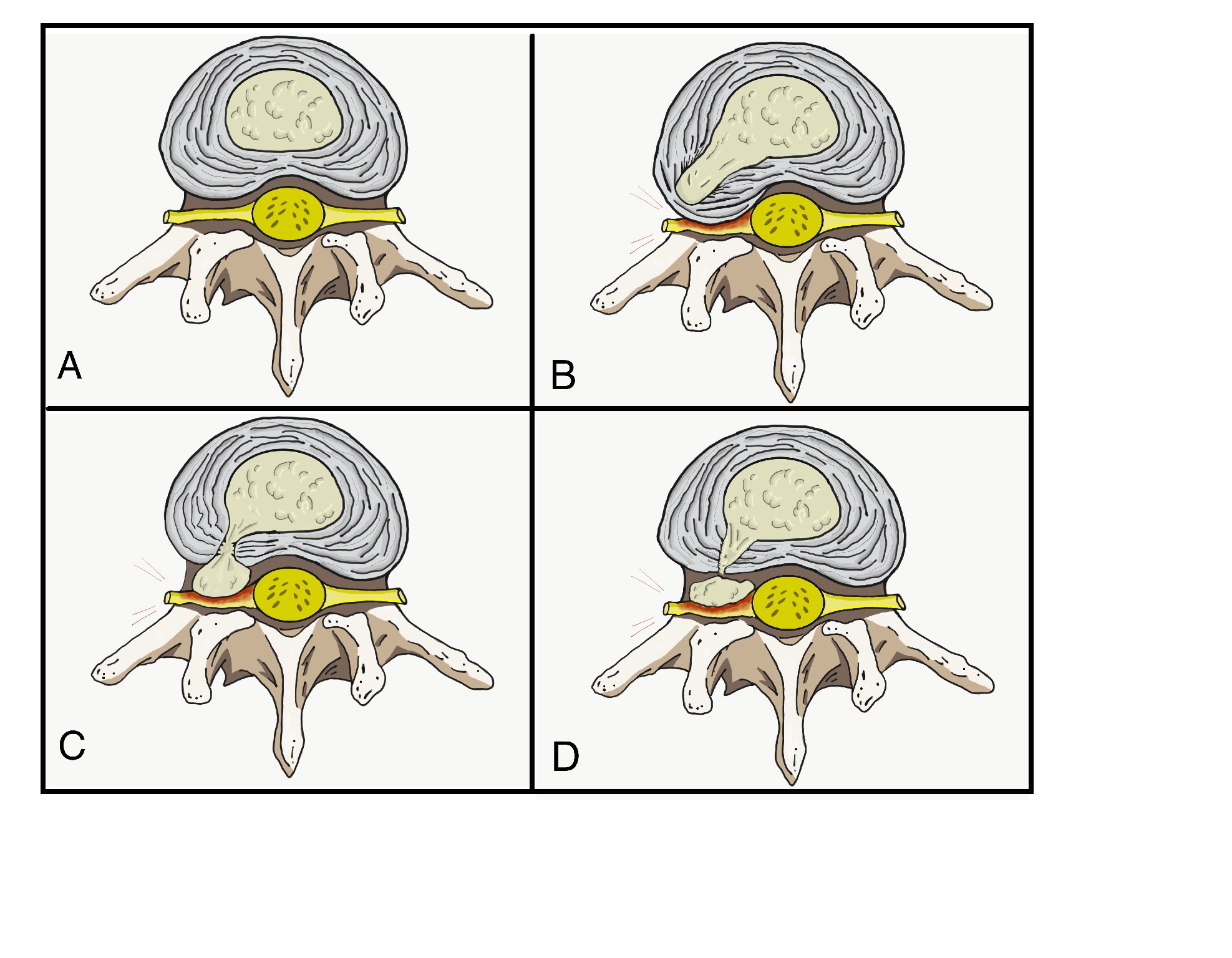 Figure 1. A) Normal disc anatomy B) Disc Protrusion C) Disc Extrusion D) Disc Sequestration
