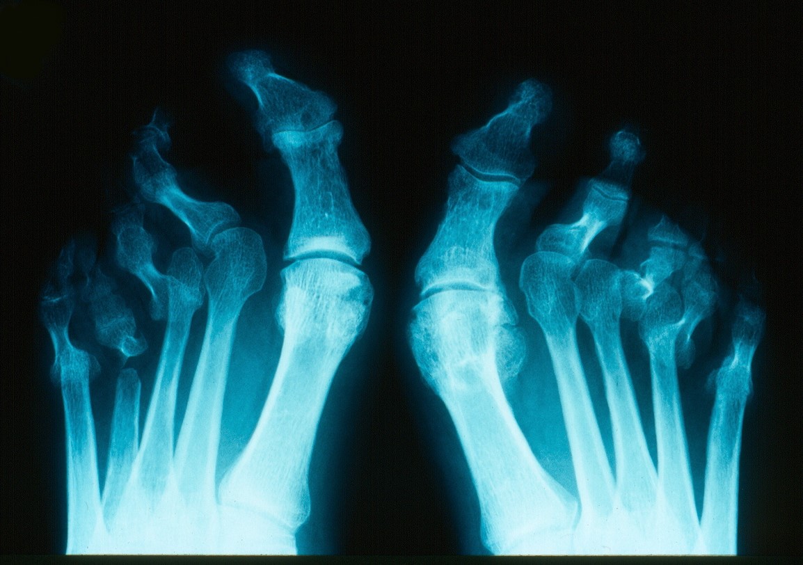 X-ray showing arthritis mutilans of feet