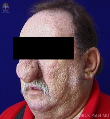 48-year-old male presents with difficulty breathing which has worsened over the last two years. Patient has rhinophyma.