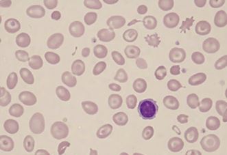 Peripheral blood picture of beta thalassemia major patient showing hypochromic, microcytic red blood cells along with target cells.