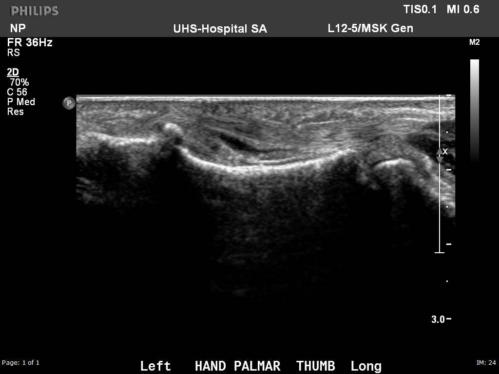 Ultrasound image of the thumb in a patient with a history of Rheumatoid Arthritis shows an abnormal amount of fluid within the flexor pollicus longus tendon sheath, consistent with an inflammatory tenosynovitis