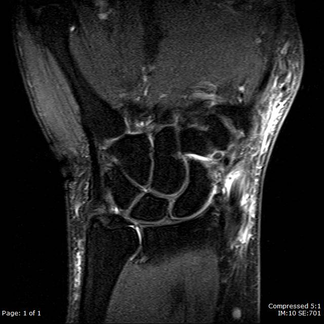 Coronal T2FS sequence of the wrist shows fluid in the first dorsal compartment tendon sheaths surrounding the abductor pollicis longus (APL) and extensor pollicis brevis (EPB) tendons with associated tendinosis and surrounding soft tissue inflammation. This is consistent with DeQuervain's tenosynovitis.