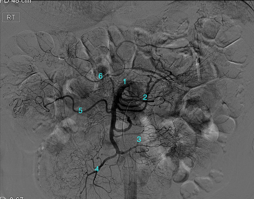 Conventional Angiogram of the Superior Mesenteric Artery (SMA). 
1. Proximal SMA   2. Jejunal branches   3. Ileal branches   4. Ileocolic artery
5. Right Colic artery    6. Middle Colic artery