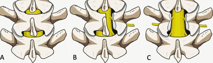 Figure A) Normal posterior vertebral arch Anatomy B) Hemilaminectomy C) Laminectomy