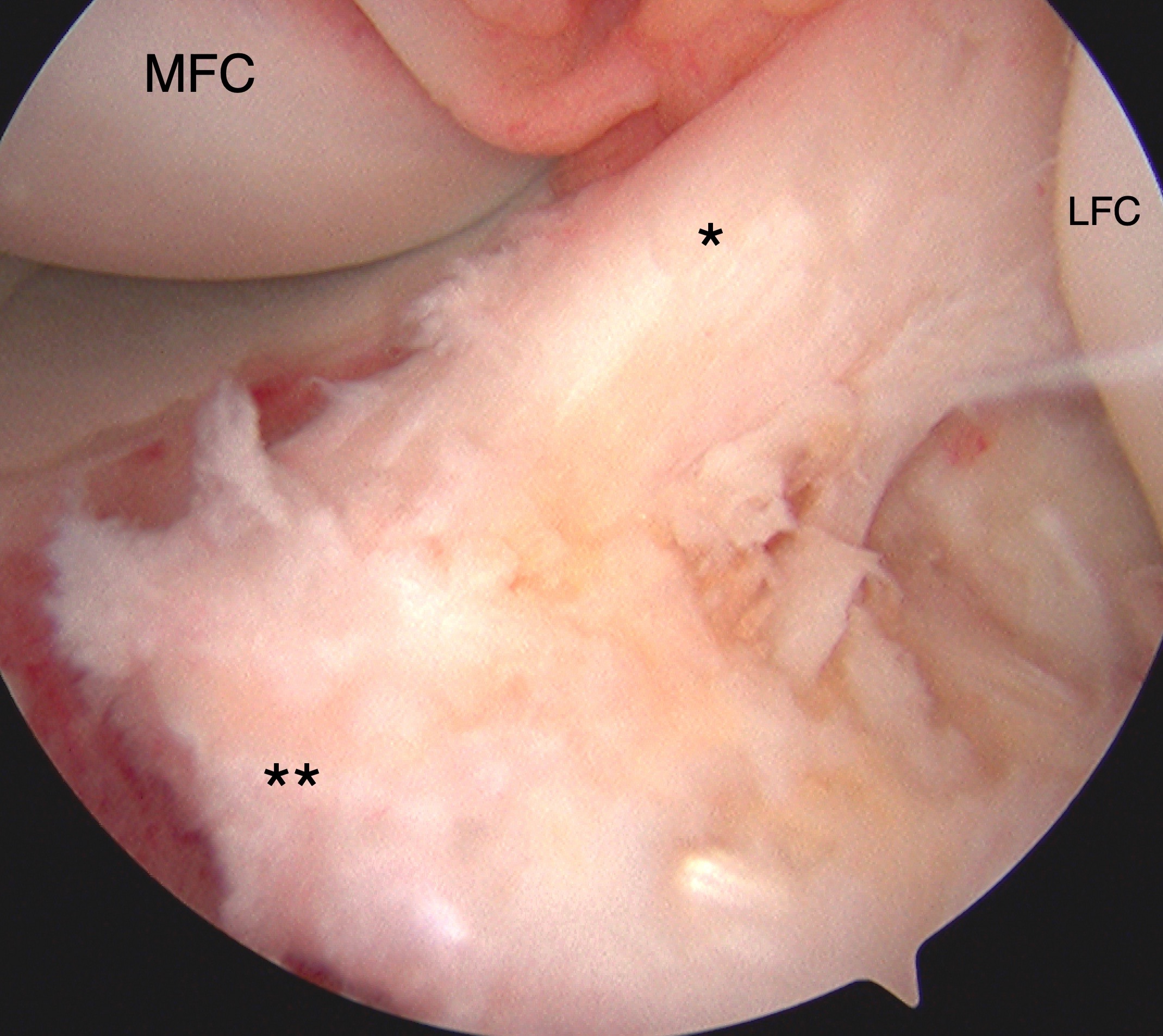 Tibial eminence avulsion injury confirmed with direct visualization during knee arthroscopy with arthroscopic-assisted internal fixation suture reduction technique.  The anterior cruciate ligament (*, ACL) and insertional footprint on the tibia (**) are denoted.  The medial (MFC) and lateral (LFC) femoral condyles are also labeled for reference.