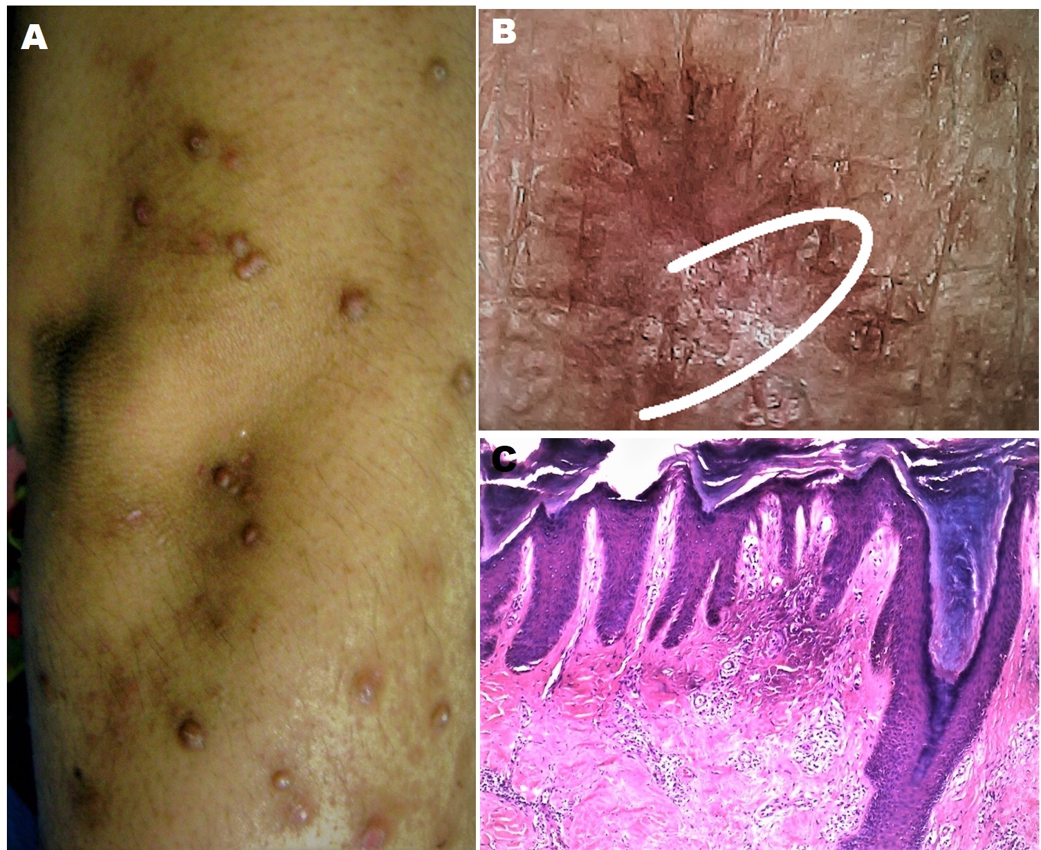Figure 1 PRURIGO NODULARIS involving the limbs of a 65-year old lady: A, Clinical Image showing the typical hyperpigmented papules and nodules over the right upper extremity with excoriations; B, Polarized dermoscopic image from a papule showing an irregularly-shaped large reddish-brown clod with localized white structureless area (white arc), with interspersed red and brown colored dots and pigmented granules [Escope, USB Videodermoscope, 30X; Timpac Healthcare Pvt
