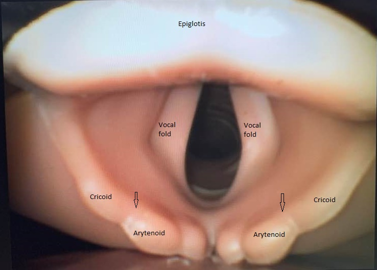 Laryngeal anatomy as seen during laryngoscopy. Arrows point to the cricoarytenoid joints. 