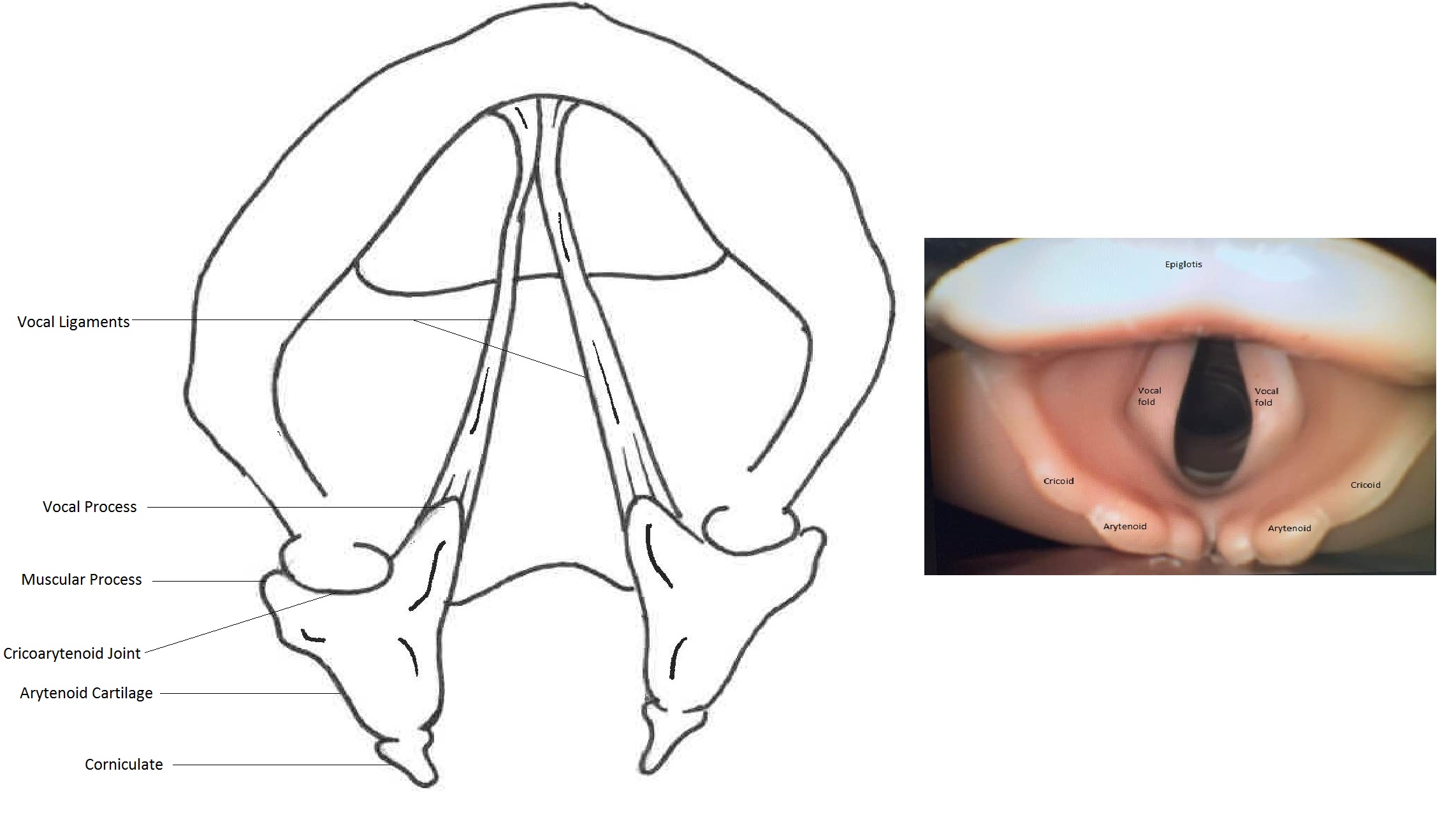 Illustration of laryngeal anatomy (left) and laryngeal anatomy as seen during laryngoscopy.
