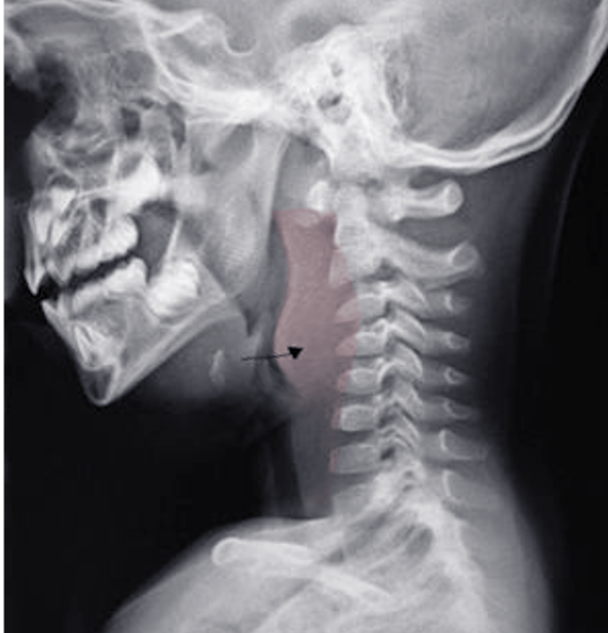 <p>Retropharyngeal Abscess on X-ray Imaging. A retropharyngeal abscess can be identified through a lateral neck x-ray.</p>