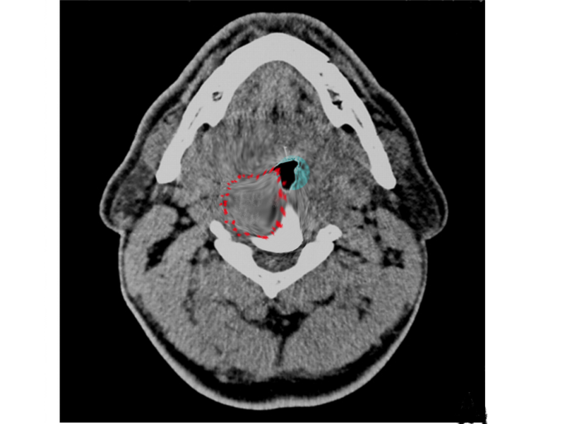 <p>Retropharyngeal Abscess on CT Imaging