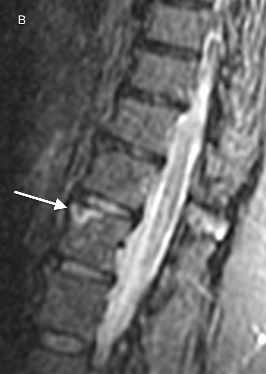 Spinal cord atrophy following a spinal cord infarction