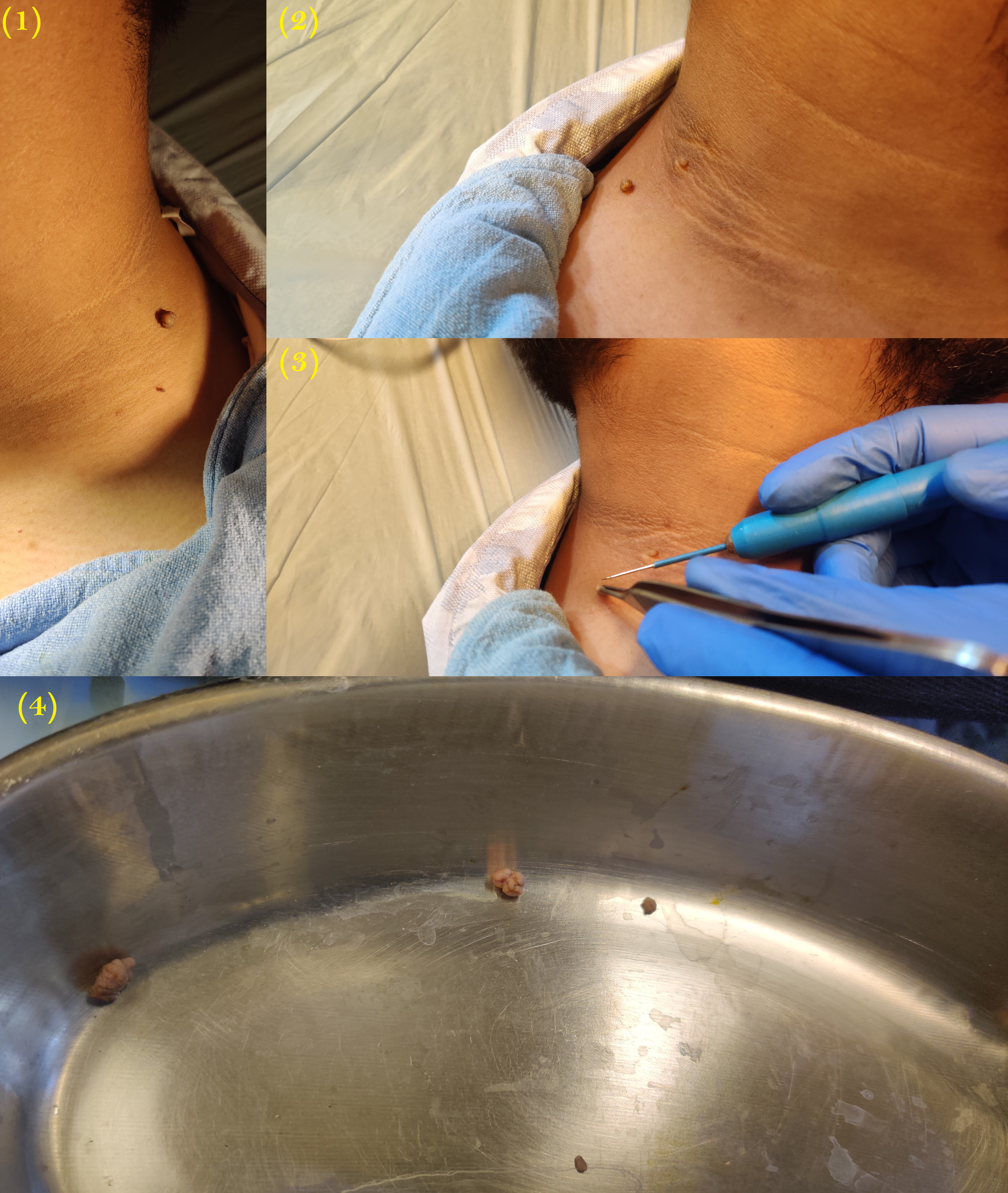 Images of skin tags and their removal using the radio cautery in the area surrounding the neck region
