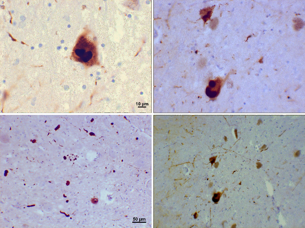 Alpha-synuclein deposits, Lewy bodies, Pathology, Histology, Substantia Nigra