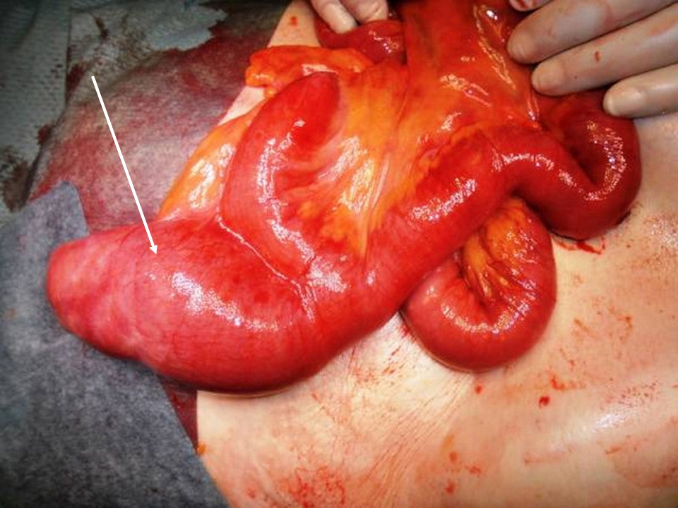 The picture shows a Meckel Diverticulum (white arrow).