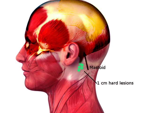 <p>Lymph Nodes of the Retropharyngeal Space