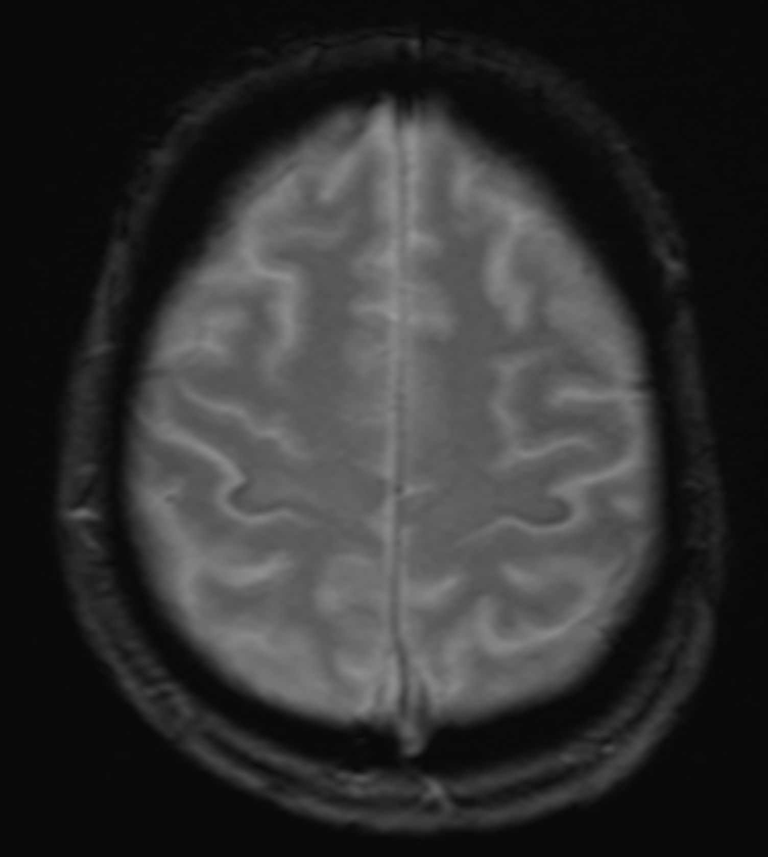 MRI GRE sequence demonstrating iron deposition in the precentral gyrus (motor band sign) in a patient with amyotrophic lateral sclerosis.