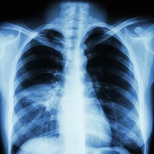 <p>Ventilator-Associated Aspiration Pneumonia. Chest radiograph showing ventilator-associated aspiration pneumonia.</p>