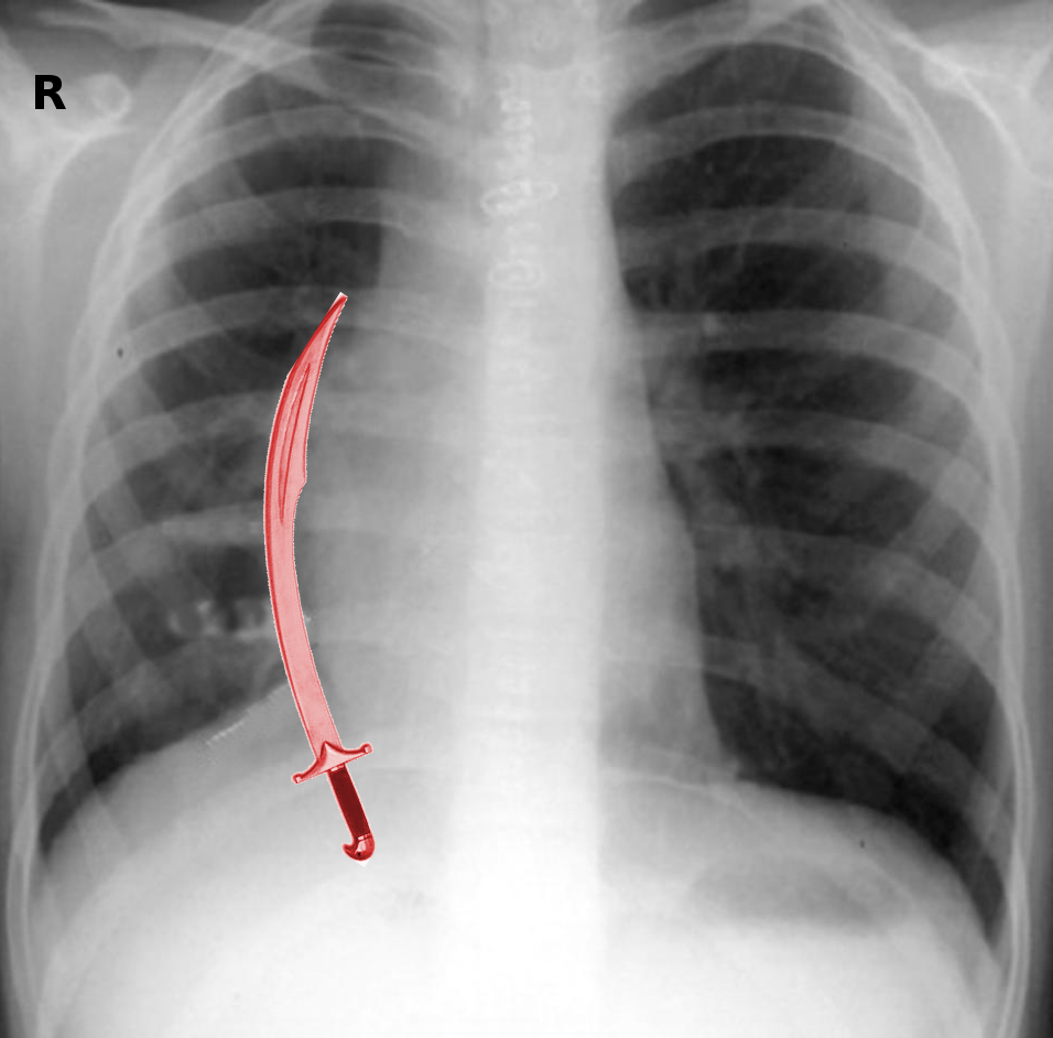 Chest x-ray in Scimitar syndrome
