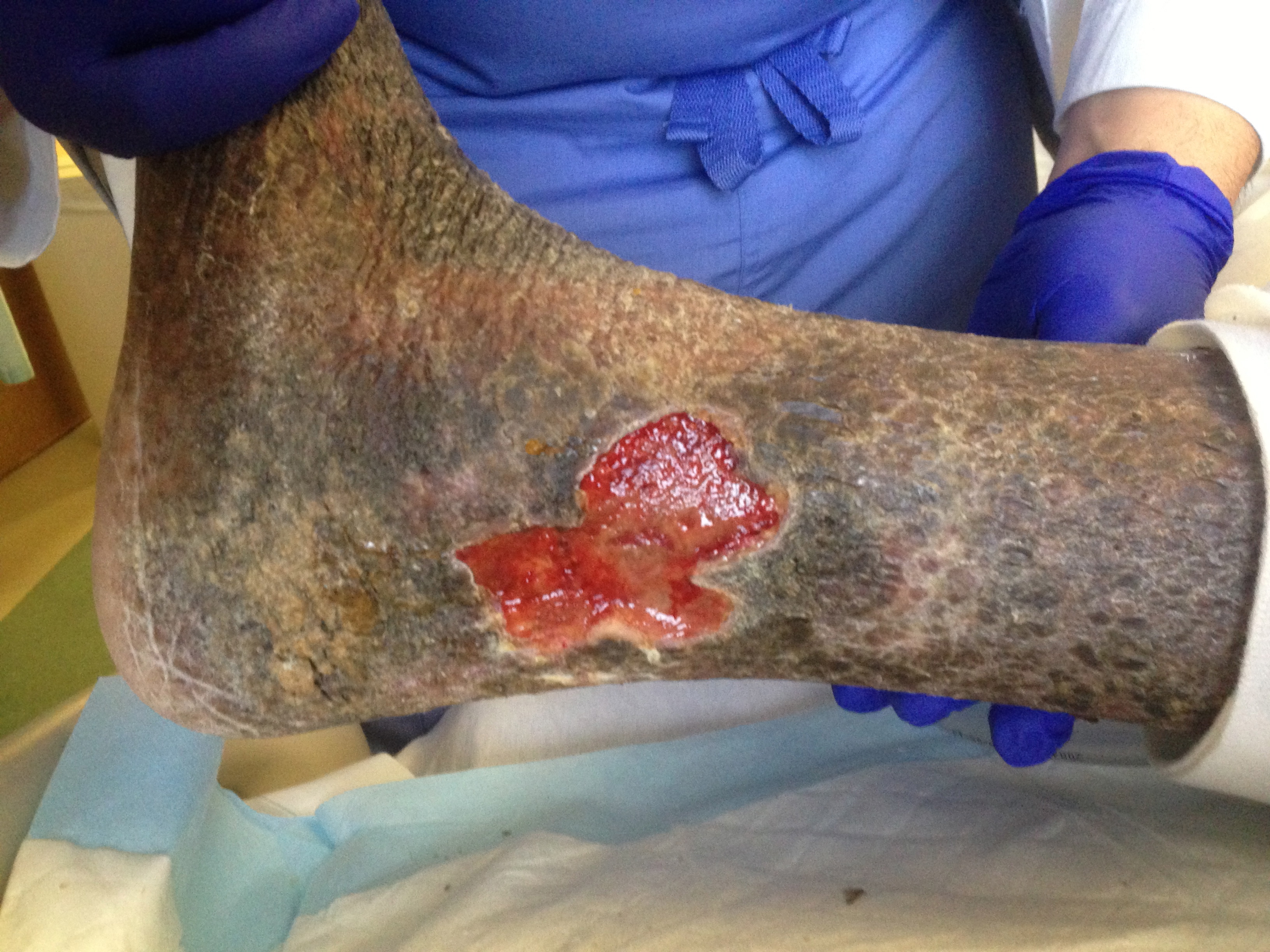 Venous stasis ulceration in classic lower medial leg (gaiter region) location. Note typical features of shallow wound base, irregular borders, healthy red granulation tissue, and surround lipodermatosclerosis.