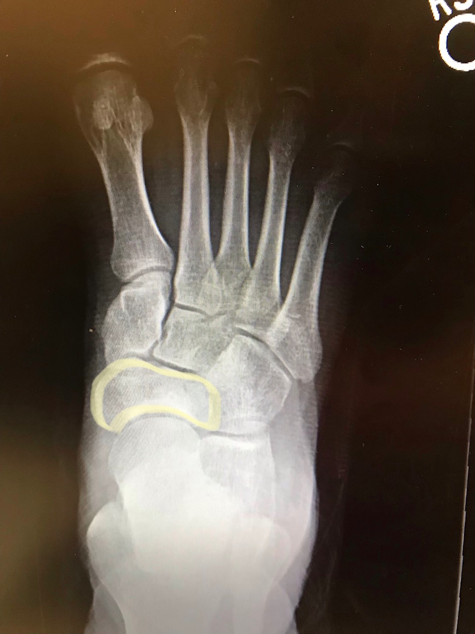 Navicular bone:
Right foot radiograph with navicular bone highlighted in yellow.