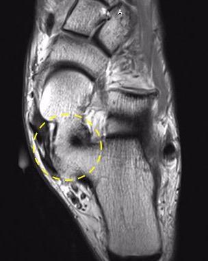 Talocalcaneal Coalition:
T1 MRI demonstrating middle facet subtalar joint osseous coalition on axial images.

