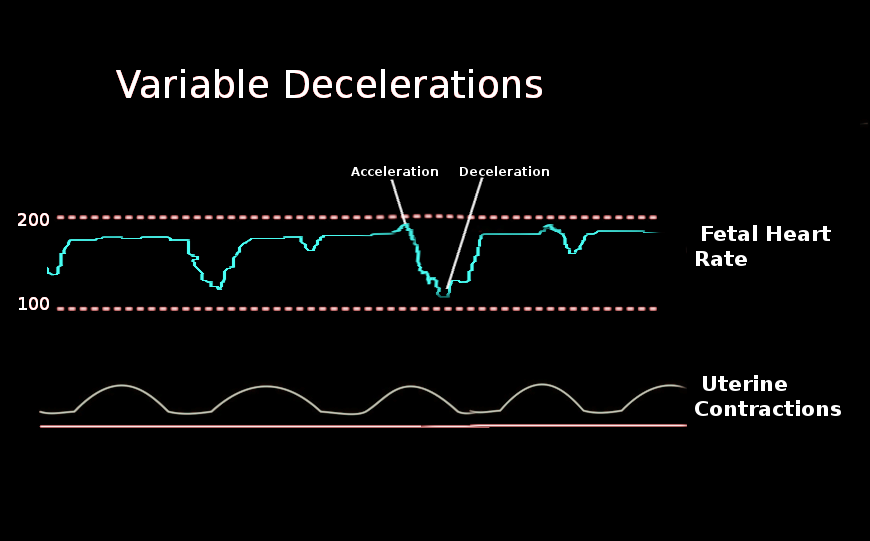 Variable decelerations