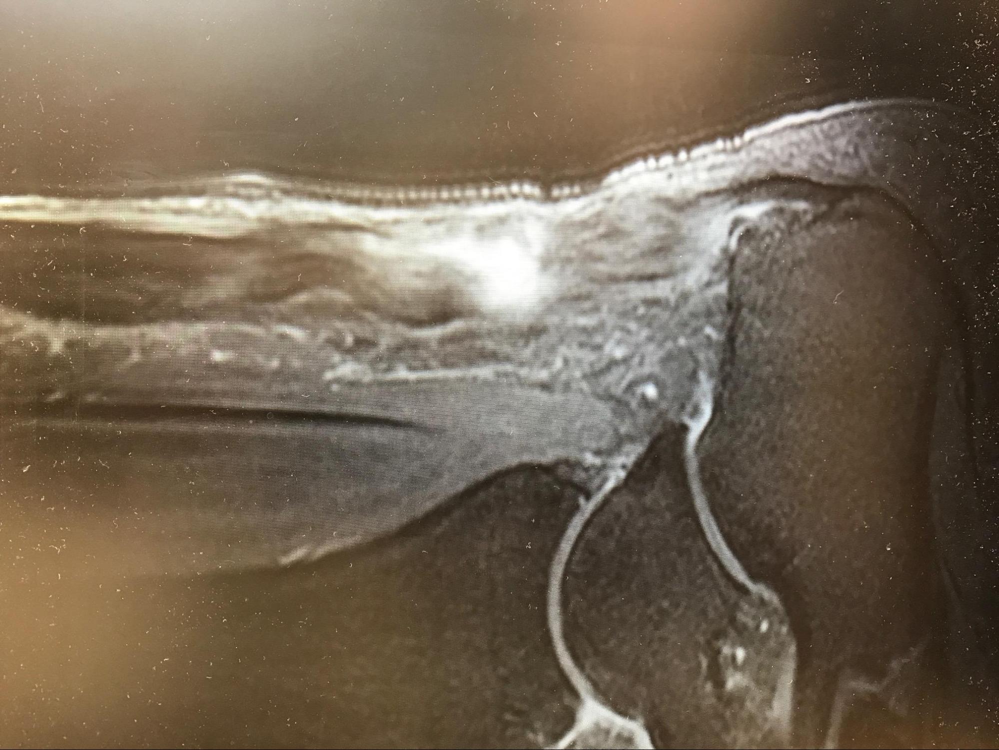 Achilles Tendon Rupture
T2 MRI demonstrating a full-thickness Achilles rupture with gapping at the classing "watershed" area.