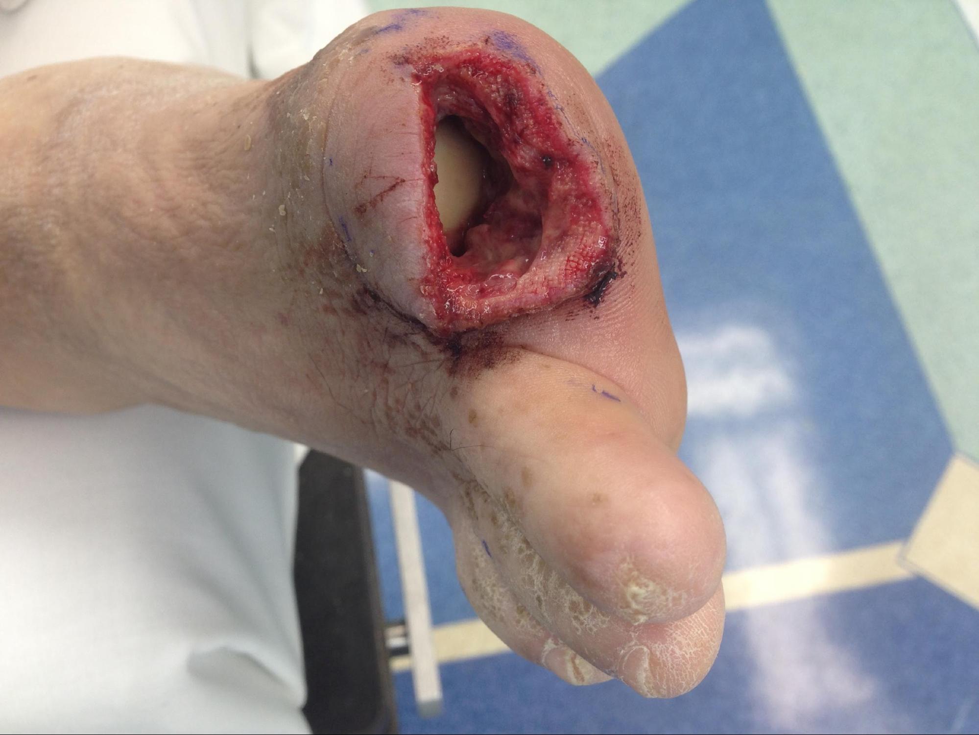 Digital Amputation
Surgical amputation of the right hallux secondary to osteomyelitis. 
Not the Exposed 1st metatarsal head within the wound. 