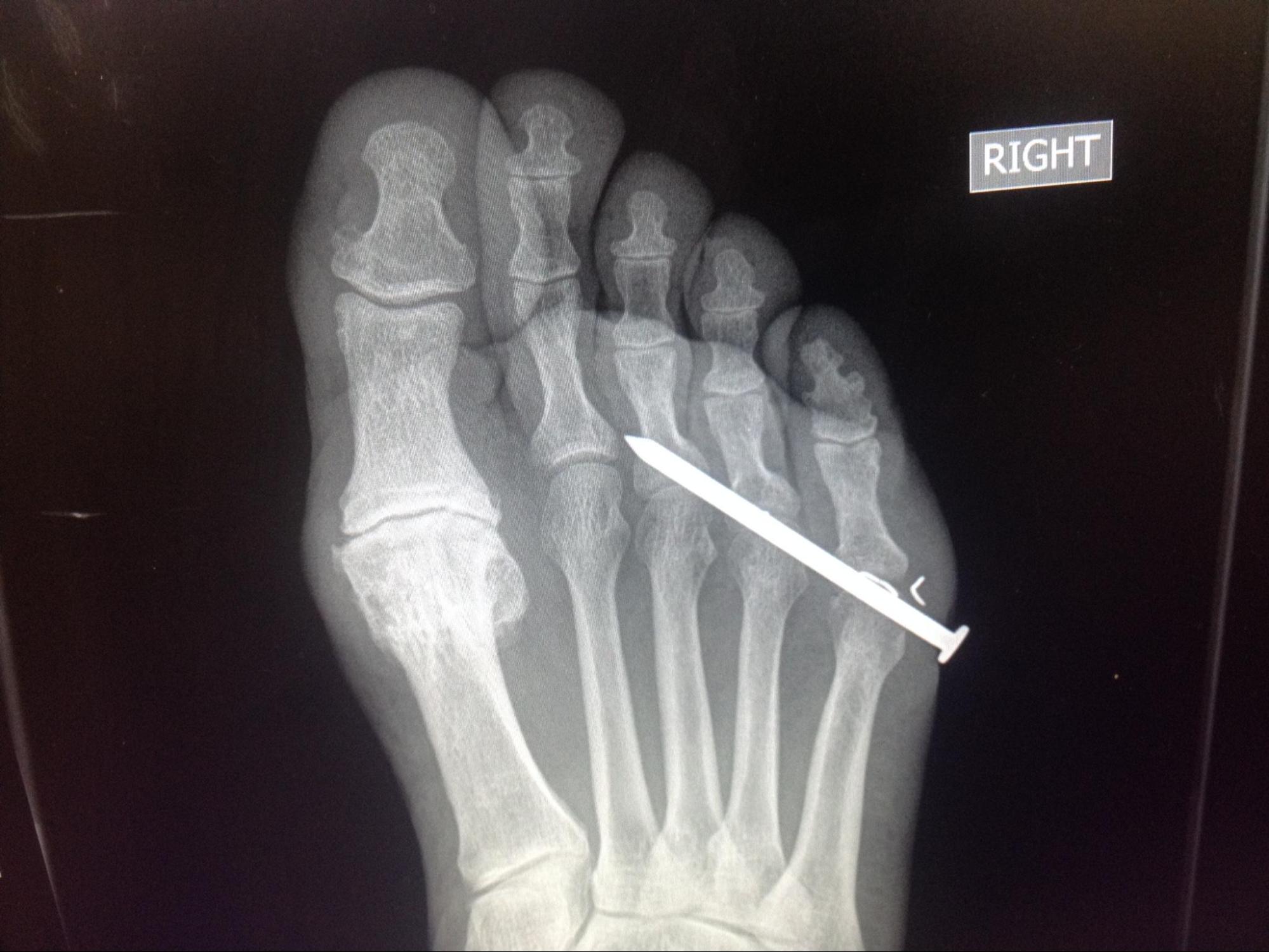 Foreign Body Imaging
Foot radiograph with metallic foreign body (nail). 