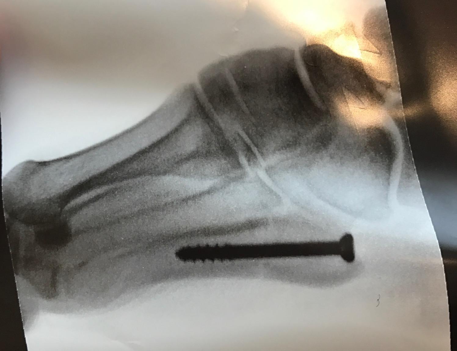 Jones Fracture
Jones fracture status post intramedullary screw fixation