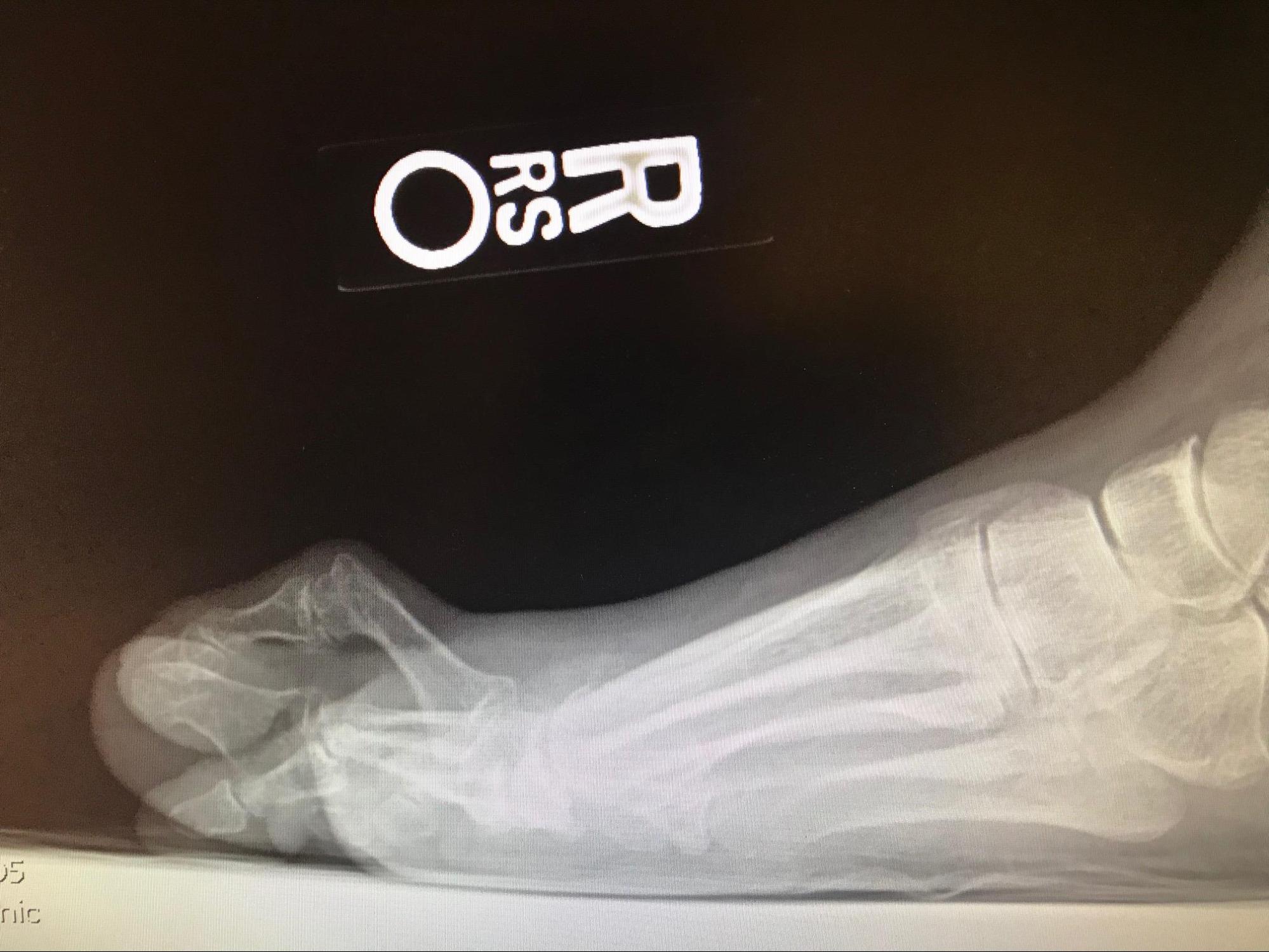 Hammertoe
Lateral weight-bearing radiograph demonstrating a hammertoe deformity with extension at the MPJ and contracture at the PIPJ