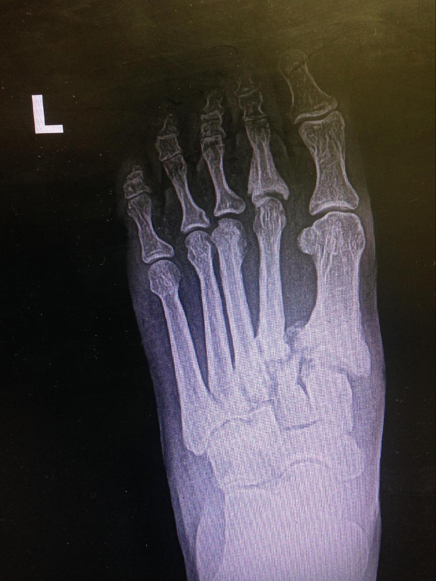 Lisfranc Dislocation
Tarsometatarsal fracture-dislocation. 
Note the communication and dislocation at the tarsometatarsal joints. 