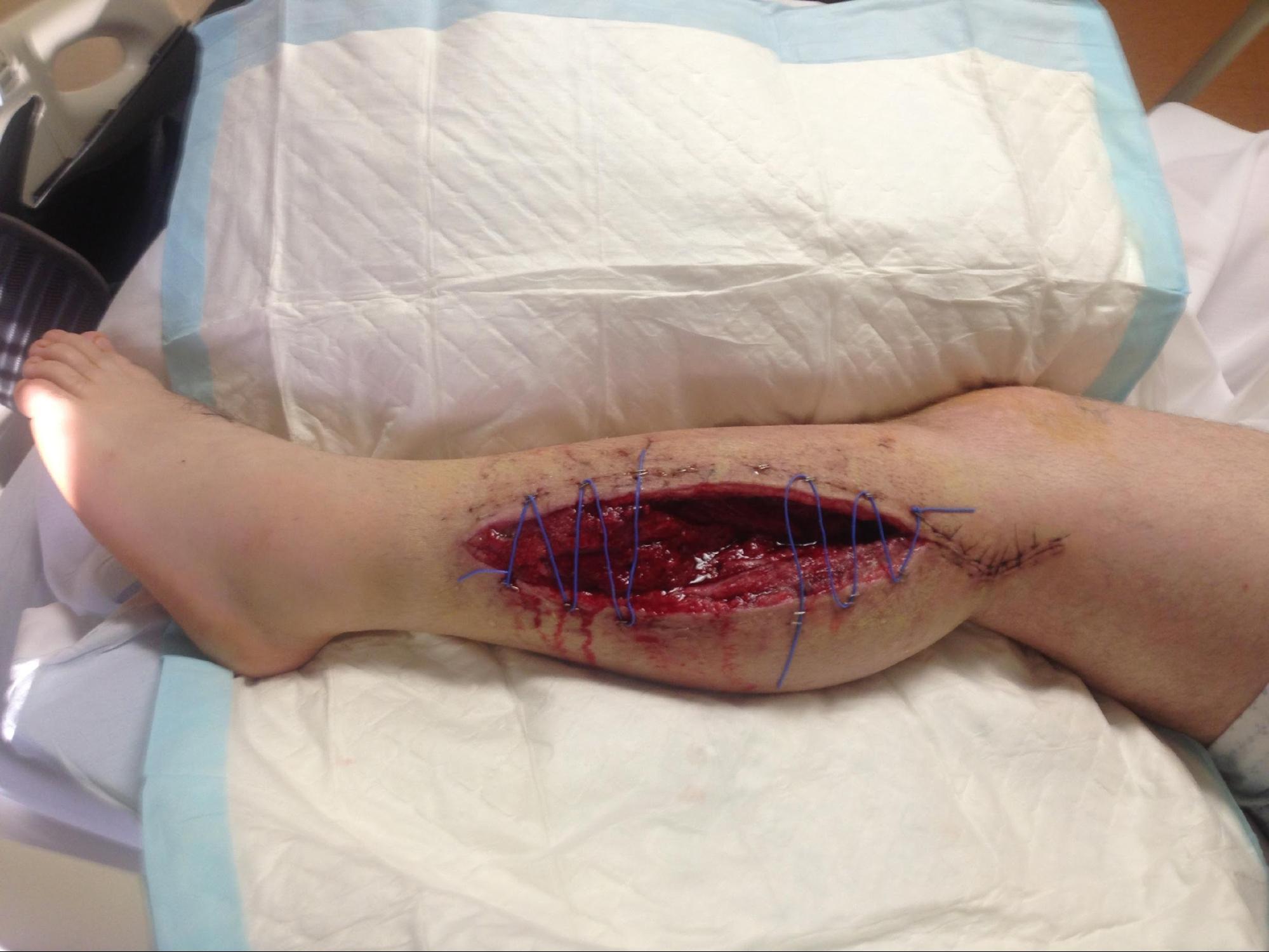 Acute Compartment Syndrome
Fasciotomy secondary to compartment syndrome of the deep leg compartment.