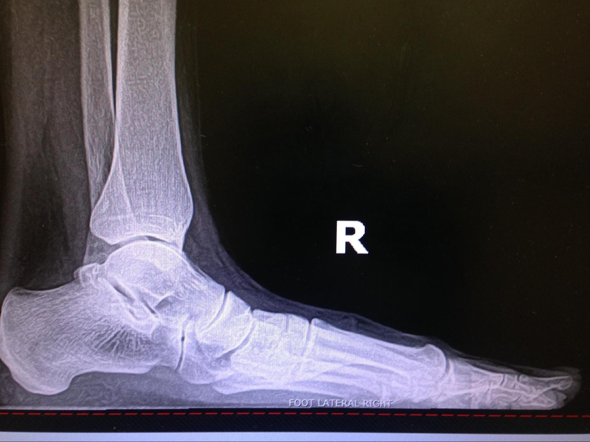 Pes Planus
Note the lack of the longitudinal arch, increased talar declination, and decreased calcaneal pitch. 
