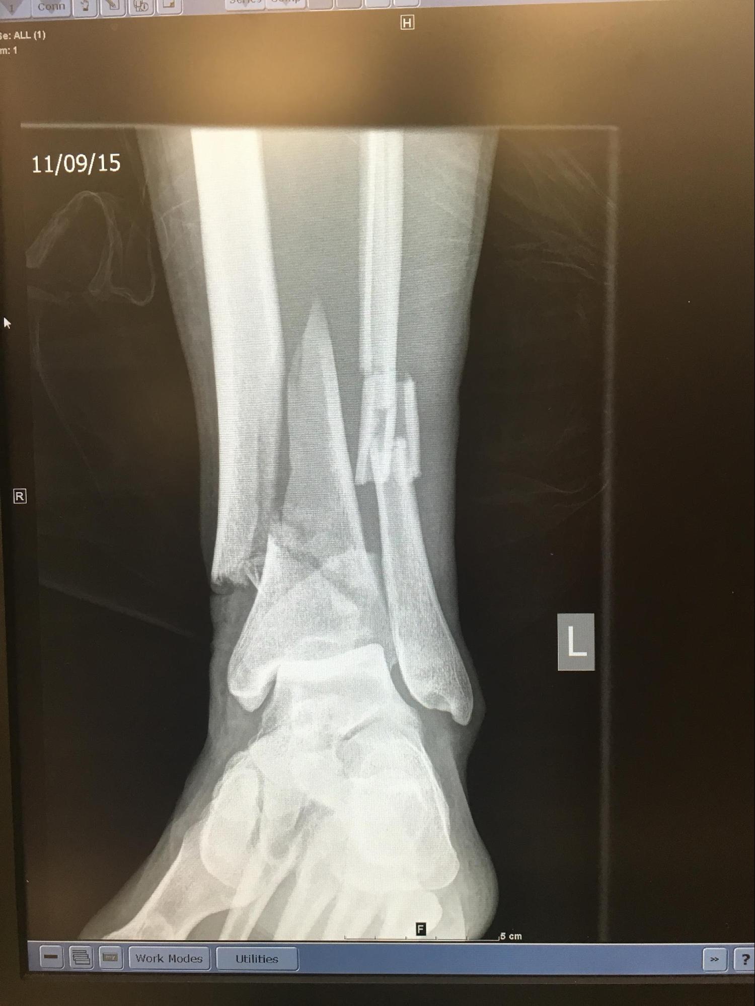 Tibial Fracture