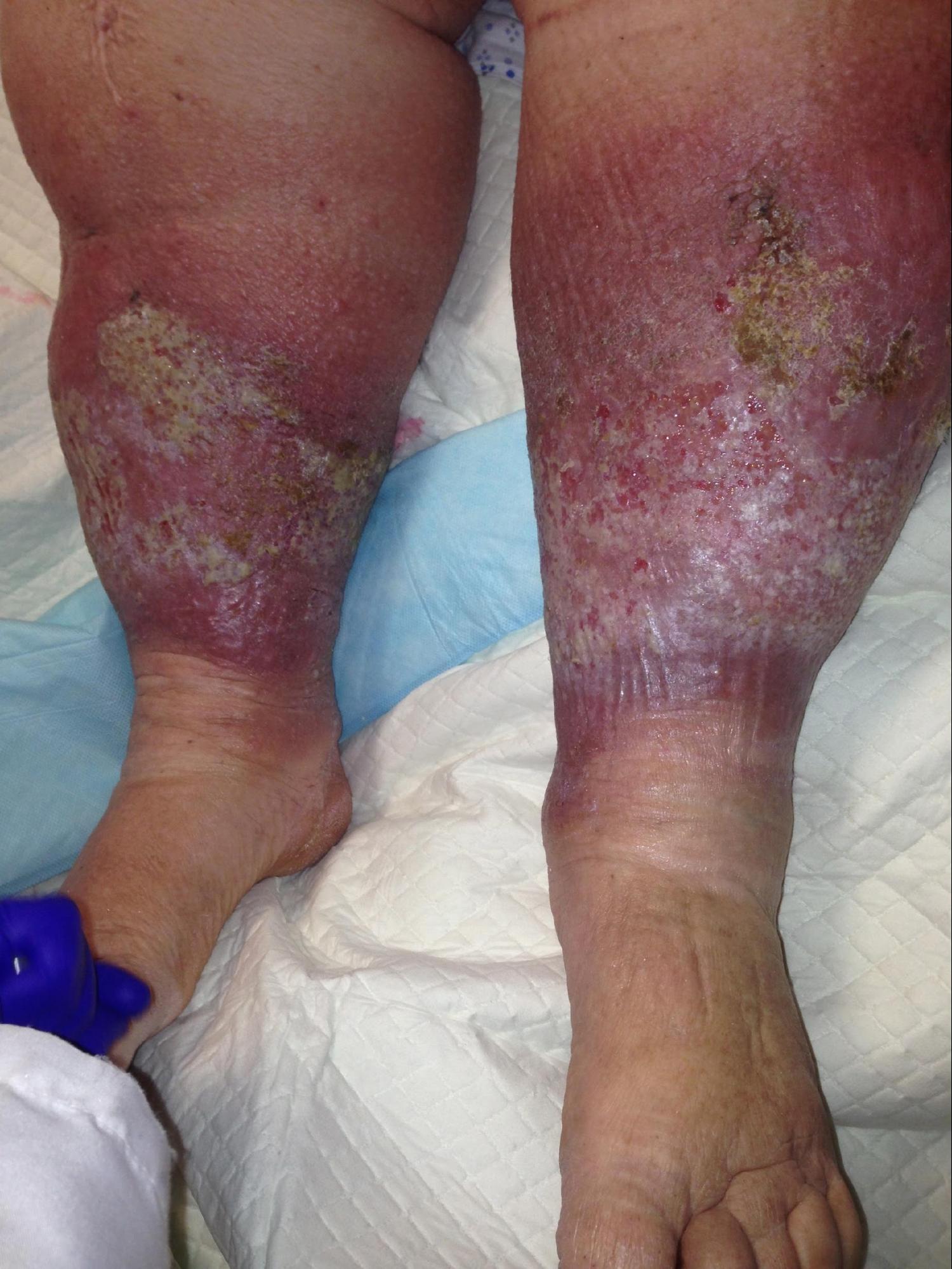 Venous Insufficiency 
Note the rubor (not cellulitis), atrophie blanche, and lipodermatosclerosis. 