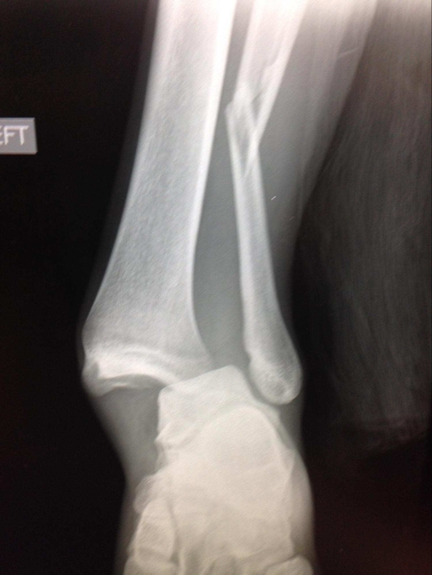 Ankle Fracture
Weber C Ankle fracture with dislocation
