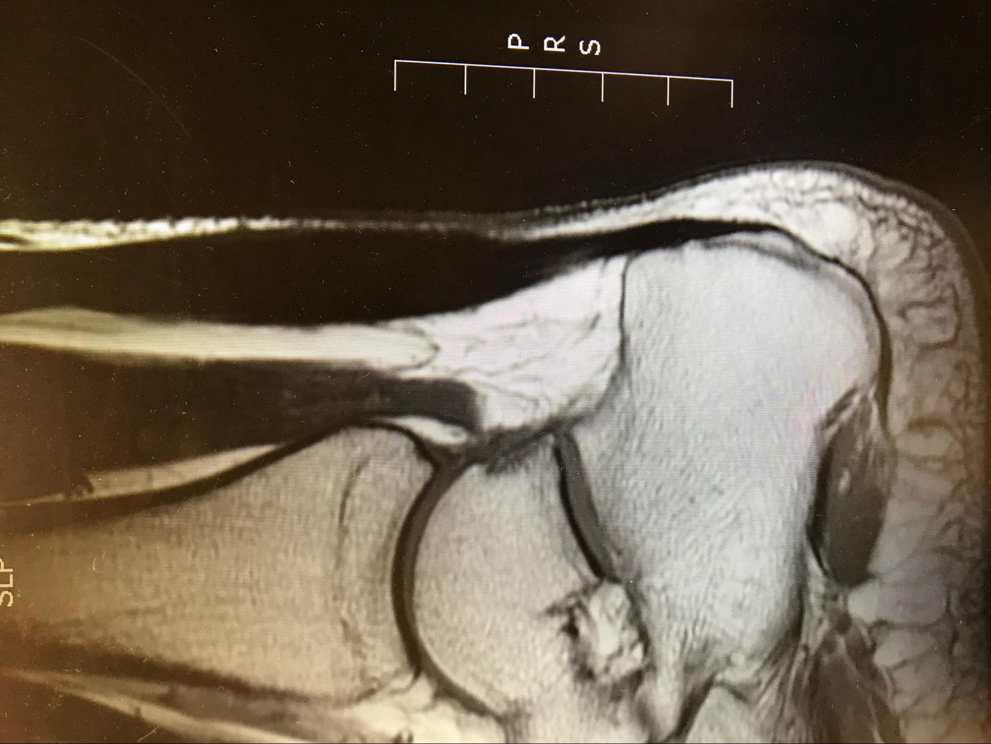 Achilles Tendonitis
T1 MRI demonstrating bulbous appearing Achilles tendon with homogenous signal.
