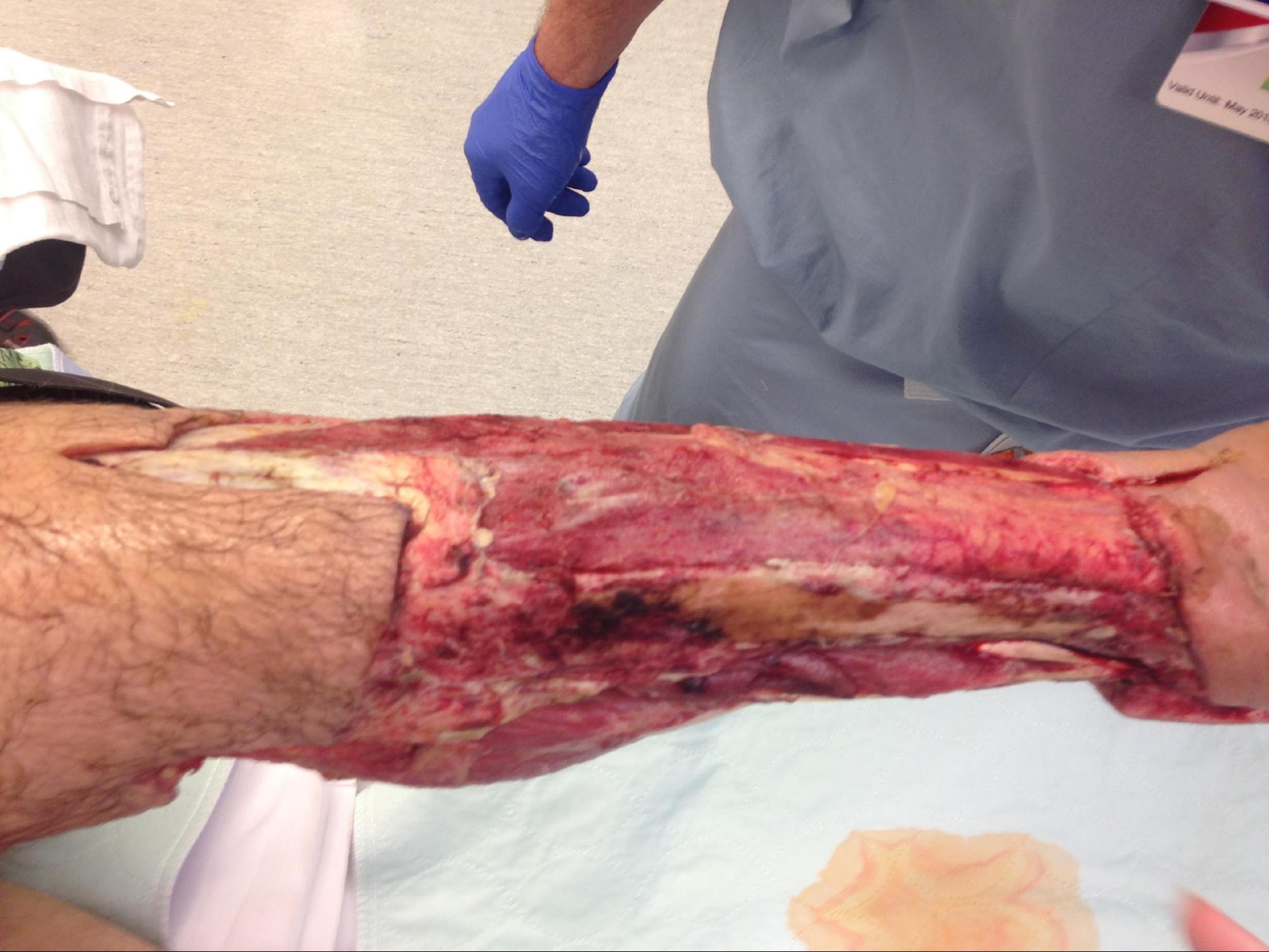 Necrotizing Fasciitis
Appearance of lower leg after serial debridements of skin and fascia. 