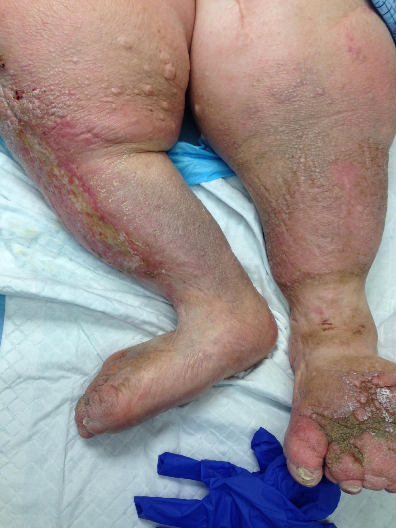 Lymphedema 
Stage 4 Lymphedema; note the skin changes, edema, fibrosis, and papillomas. 