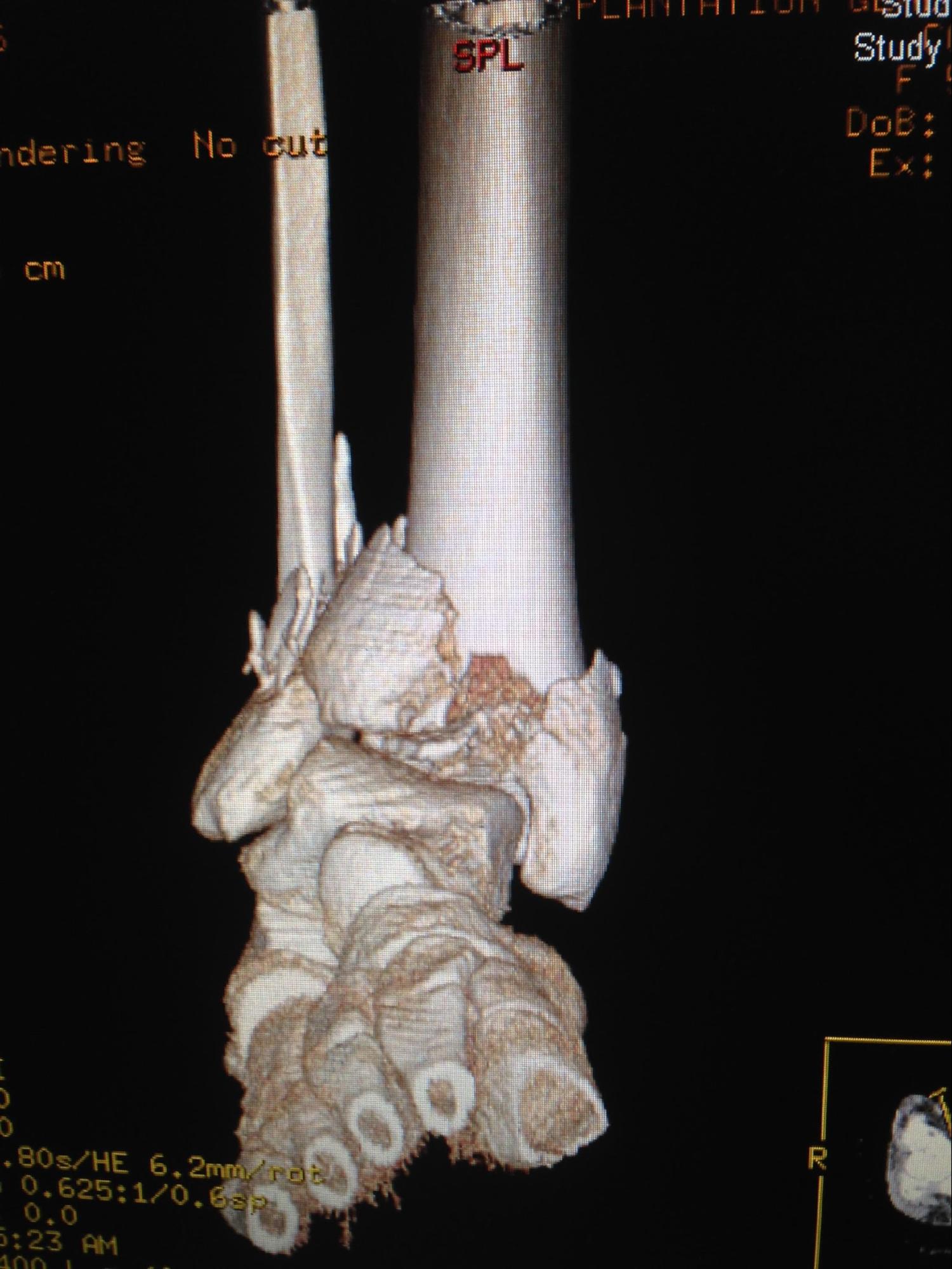 Pilon Fracture
3D CT scan of a pilon fracture. 
Note articular impaction and comminution of the tibial plafond.