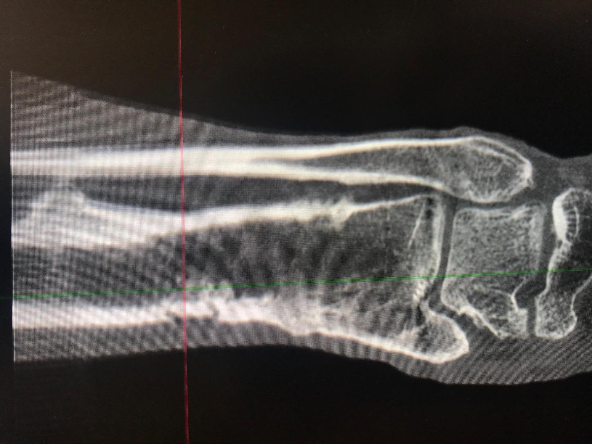 Osteomyelitis 
CT Scan of Chronic osteomyelitis of the leg demonstrating classic cloaca, sequestrum and involucrum 