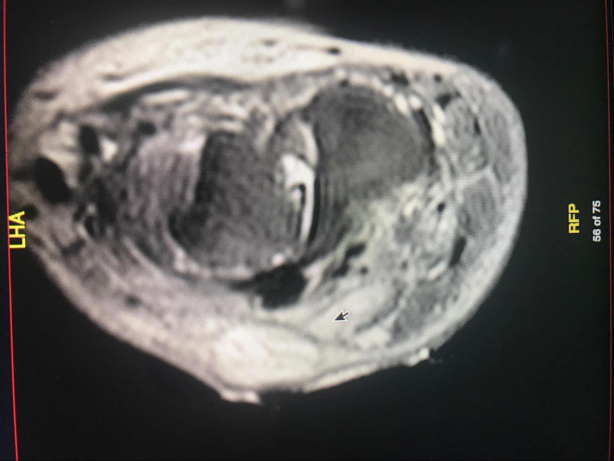 Osteomyelitis
CT Scan of chronic osteomyelitis of the leg demonstrating classic cloaca, sequestrum, and involucrum 