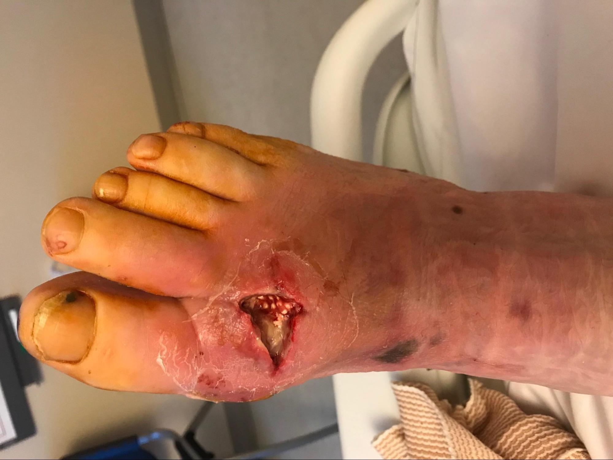 Diabetic Foot Infection
Status post incision and drainage with insertion and antibiotic beads. 